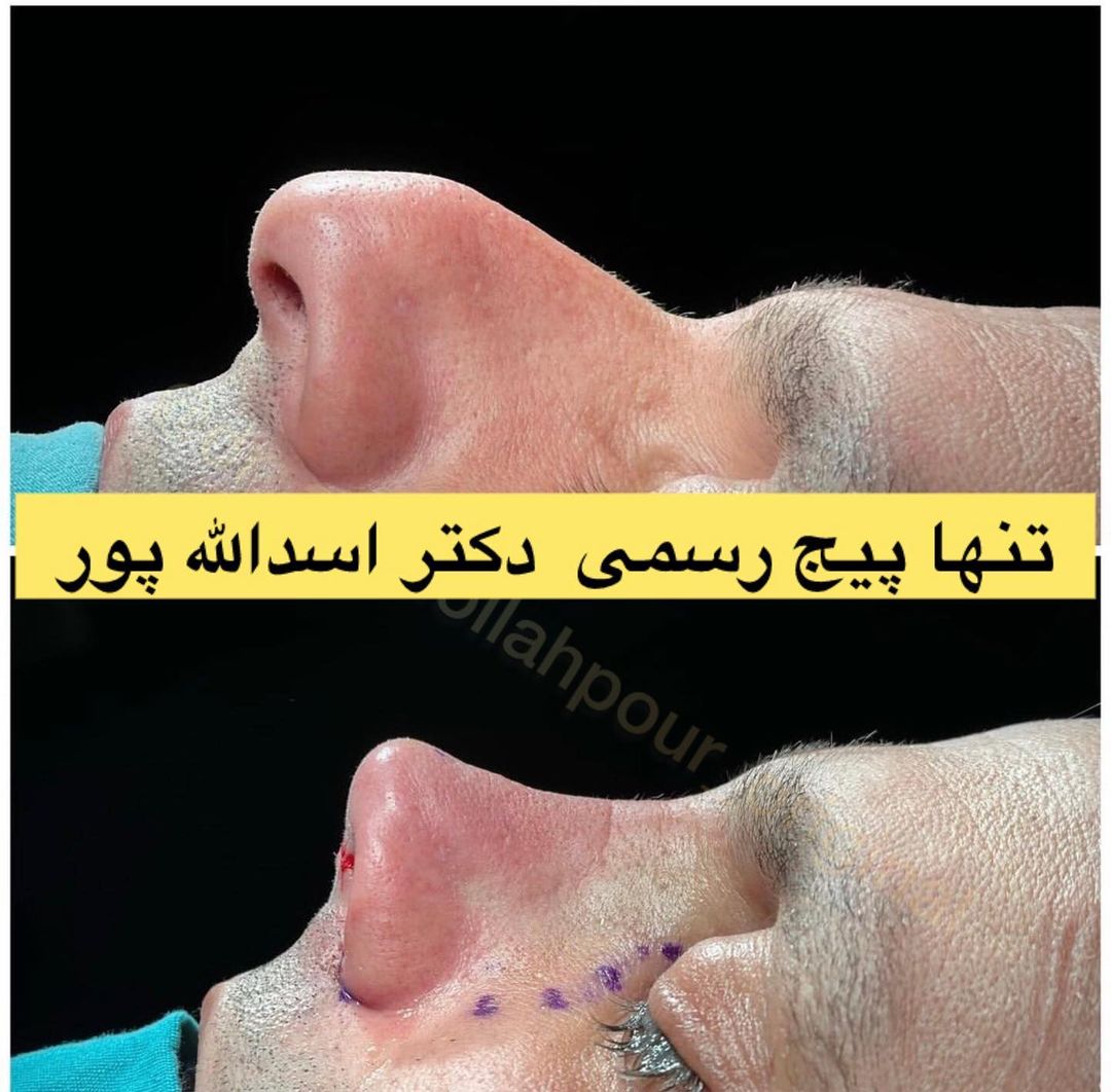 بینی‌ای زیبا و طبیعی هدیه‌ای برای خودتان
